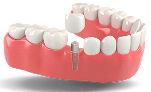 Dental Clinic Delhi Best Dentist in Delhi, For Painless RCT, Dental  Implant, Single tooth Implant, Braces treatment, Invisible braces cost in  Delhi
